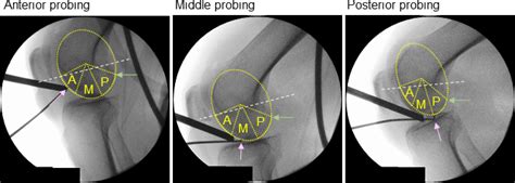 Association Between Knee Cartilage Thickness Determined By Magnetic