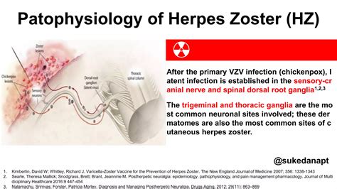 Postherpetic Neuralgia Pptx