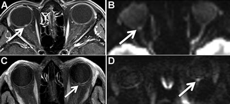 diffusion weighted imaging  post contrast enhancement