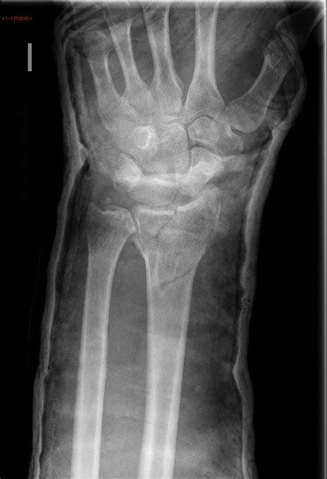 FRACTURAS DE RADIO DISTAL