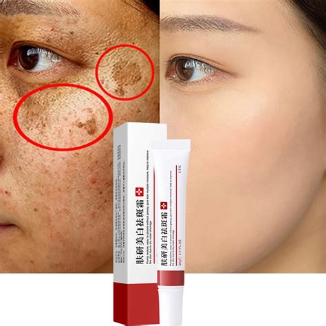 Whitening Freckle Cream Remove Melasma Cream Remove Dark Spots Melanin