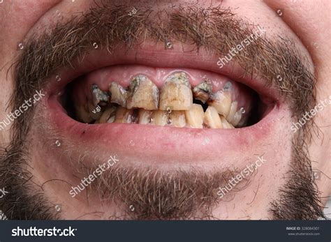 Bad Teeth Smoker Sick Stock Photo 328084301 Shutterstock