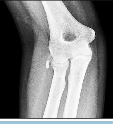 Figure From Calcific Periarthritis Of The Elbow Presenting As Acute