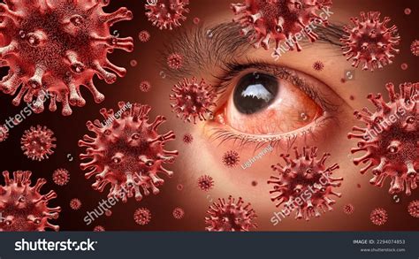 Viral Conjunctivitis