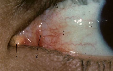 Lacrimal Caruncle