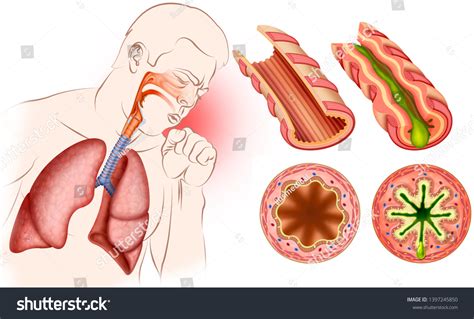 2,800 Airway Bronchi Images, Stock Photos & Vectors | Shutterstock