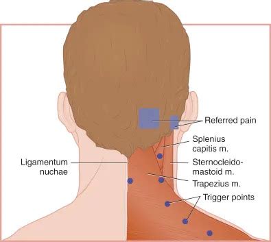 การรกษาอาการปวดศรษะดวยการฉด Trigger point และการใชโบทลนมทอกซน