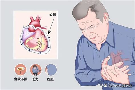 55歲男子多次心梗前兆未重視，5點心臟停跳！科普：心梗前兆 每日頭條