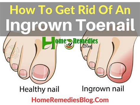 How To Get Rid Of An Ingrown Toenail Painlessly - Home Remedies Blog