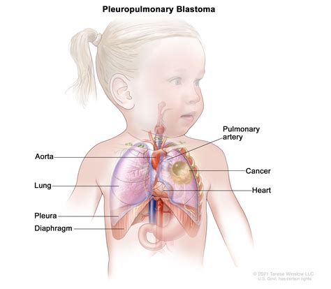 Pleuropulmonary Blastoma NCI