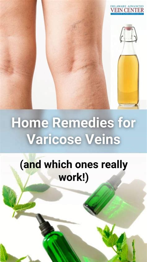 Spider Vein Remedies Artofit