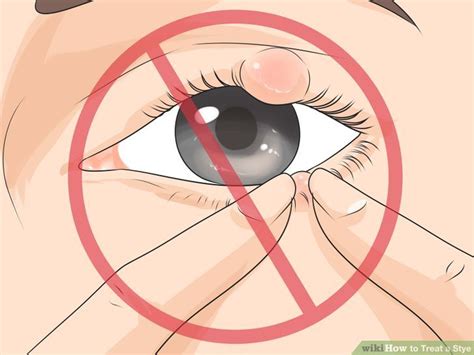 Stye Prevention and Remedies – Eye Stye Treatment | Diethics.com