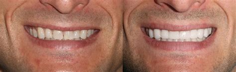 Dental Veneers Dr Desiree Yazdan Newport Beach