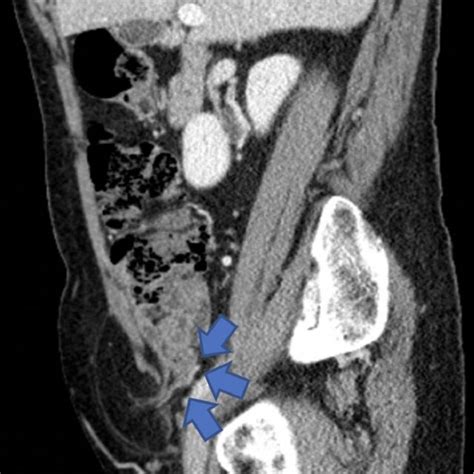 Ct Scan Abdomen Pelvis Axial Showing The Groin Hernia Download