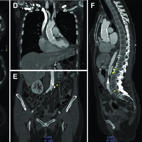 Post Transapical Thoracic Endovascular Aortic Repair TaTEVAR