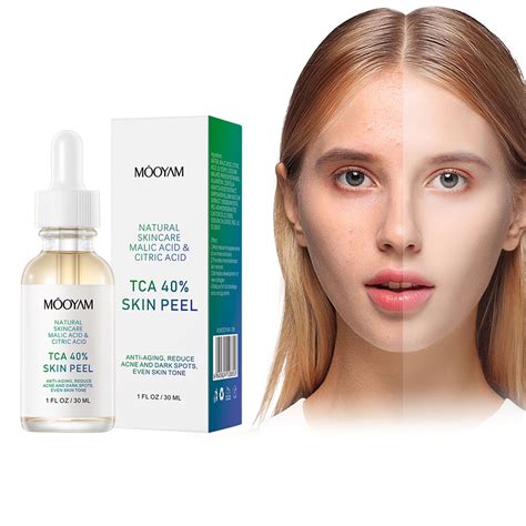 El exfoliante químico facial se aplica a la eliminación del acné y las