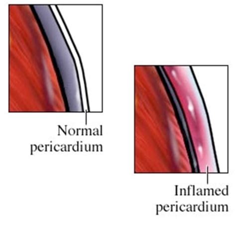 111 Pericardial Disease Myocarditis Endocarditis Rheumatic Heart