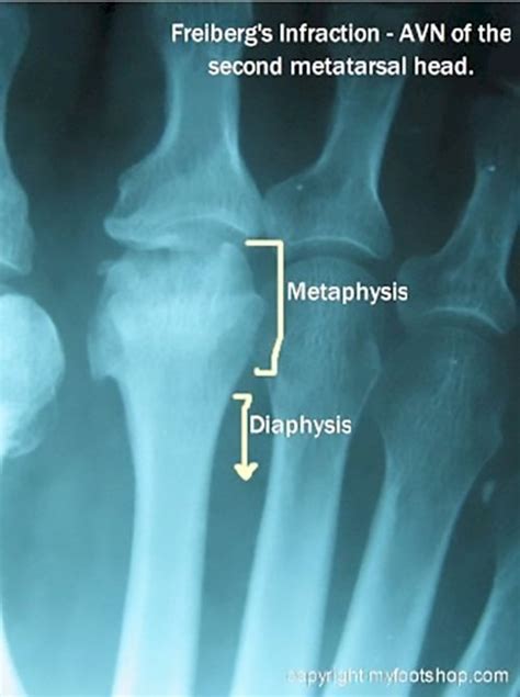 Freibergs Infraction Causes And Treatment Options