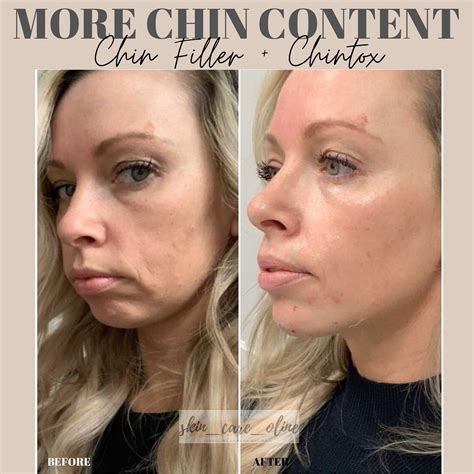 Voluma Botox Chinfiller Chintox Chinrejuvenation Rehydrate Chin