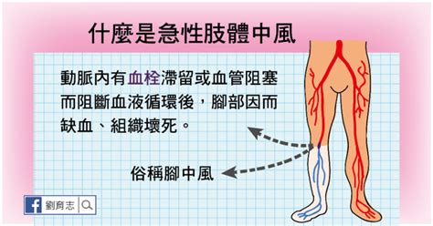 照護線上》腳也會中風！注意急性肢體中風的5個警訊（懶人包） 自由評論網