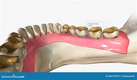 Dental Erosion, Also Known As Tooth Erosion Stock Illustration ...