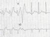 Exercise Induced Left Bundle Branch Block And Chest Pain In The Absence