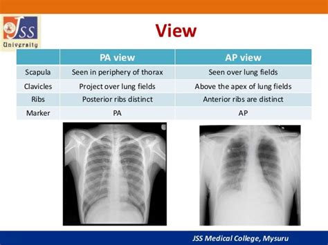 Chest X Ray Basic Interpretation