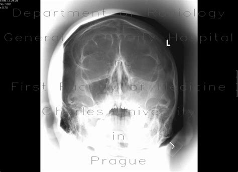 Radiology Case Polyp Of Maxillary Sinus