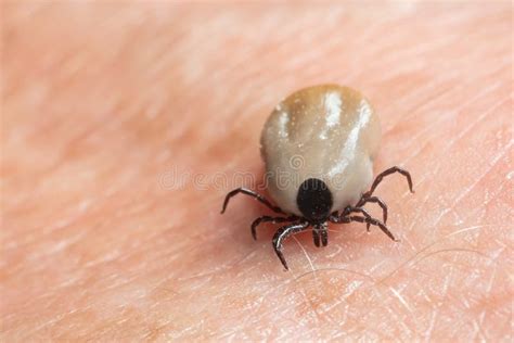 A Tick Drunk On Blood Crawls On Human Skin Stock Photo Image Of Skin