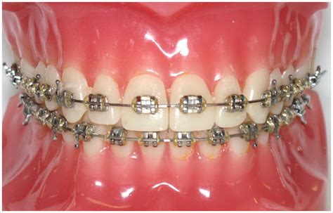 Orthodontics Wires And Braces Dental Trends