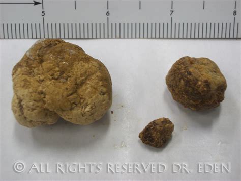 Gallstone Pictures Gallery See Images Of Real Gallstones Passed