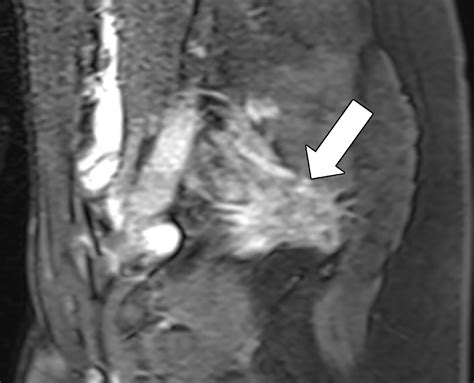 Atypical Sites Of Deeply Infiltrative Endometriosis Clinical Characteristics And Imaging