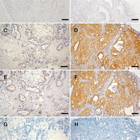 Immunohistochemical Staining Of Dkk1 β Catenin And Cd8 Download Scientific Diagram