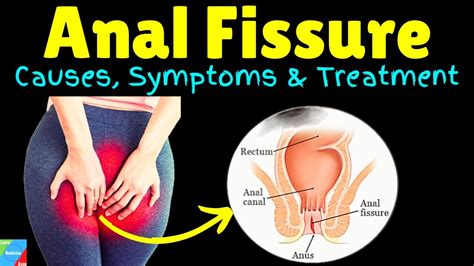 Anal Fissure Signs And Symptoms Causes Pathophysiology Diagnosis