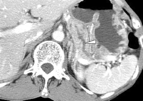 Macrocystic Neoplasms Of The Pancreas CT Differentiation Of Serous