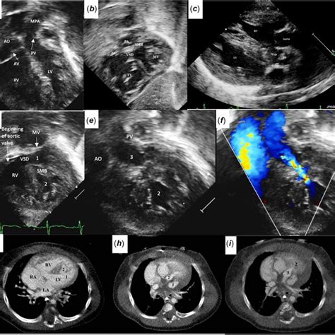 Two Dimensional Echocardiogram And Color Doppler Views A F Showing