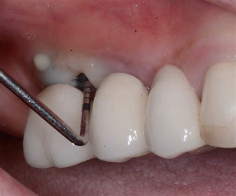 Peri Implantitis Prevent Recognize And Treat Iti Blog