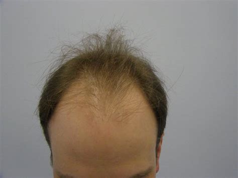 Hair Transplant Patient Gallery 17 Sure Hair International Hair Restoration Toronto