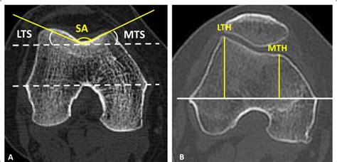 Measurements Of The Morphology Of The Femoral Trochlea A Sa Angle