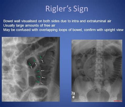 Bowel Rigler Sign Pneumoperitoneum