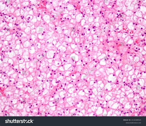 Human Liver Glycogenosis After Conventional Fixation Stock Photo ...