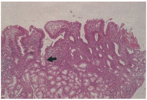 Biopsy Taken From The Margin Of The Duodenal Ulcer He Staining 40