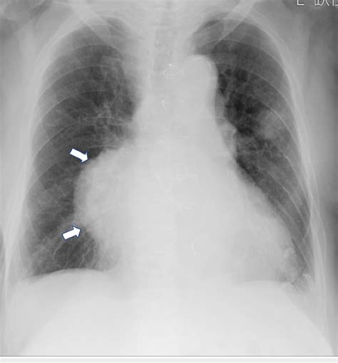 Chest X Ray Findings At Admission The Chest X Ray Shows A Large Download Scientific Diagram