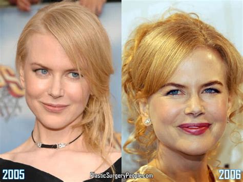 Did Nicole Kidman Have Facelift & Lip Augmentation?