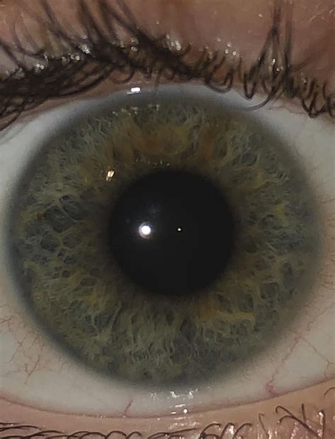 I Have An Iris Nevus Same Eye In Both Photos Reyes