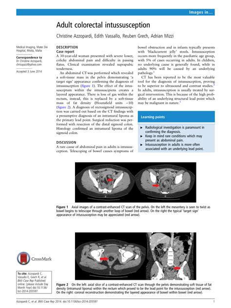 Pdf Adult Colorectal Intussusception