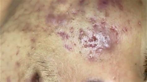 7 Unbelievable Blackhead Removal Methods You Need To Try in 2024 - 8ktvco8