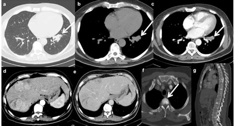 Axial A Mdct Lung Window Image Reveals A Mass Of Mm With Irregular