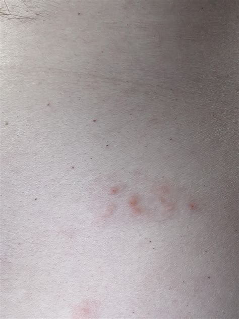 34 M Had This Rash For A Week At First It Is Red Bumby And Itchy