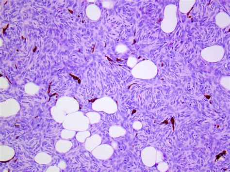 Pathology Outlines Dermatofibrosarcoma Protuberans Dfsp